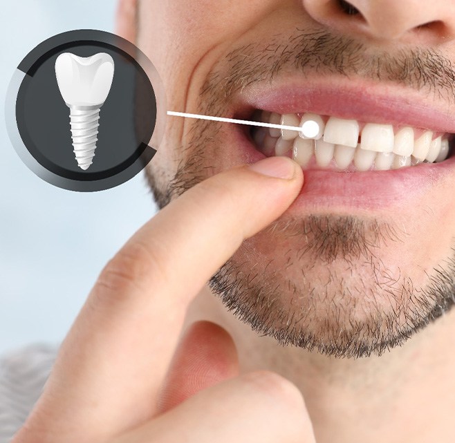 Nose-to-neck view of man touching tooth indicated as an implant