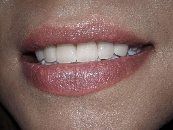 Bright white evenly spaced teeth after treatment