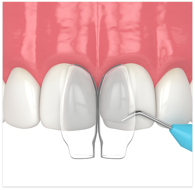 Illustration of front teeth receiving direct bonding from cosmetic dentist in Cottonwood Heights