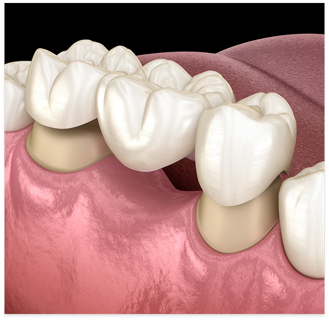 Illustration of dental bridge in Cottonwood Heights for lower arch