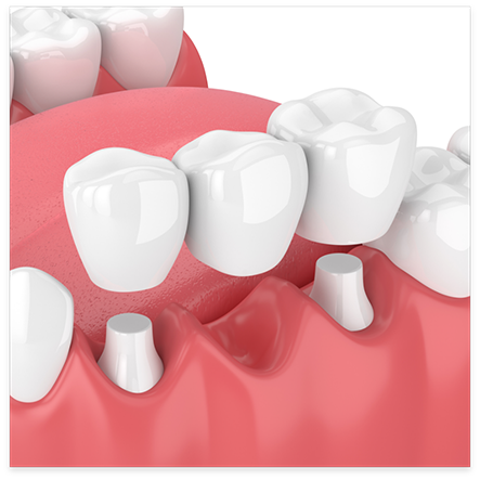 Illustration of dental bridge placed on prepared teeth