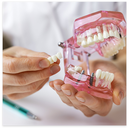 Holding dental bridge and model of mouth with dental implants