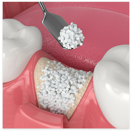 Illustration of bone graft being performed in area with lost tooth