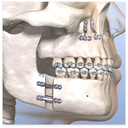 Illustration of jaw after ridge expansion