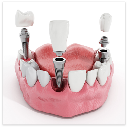 Illustration of three dental implants and crowns being placed