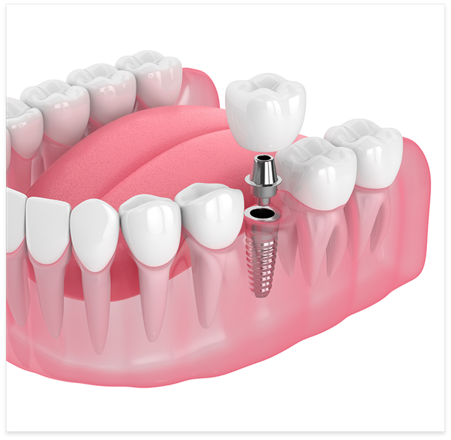 Illustration of dental implant, abutment, and crown being placed in lower jaw