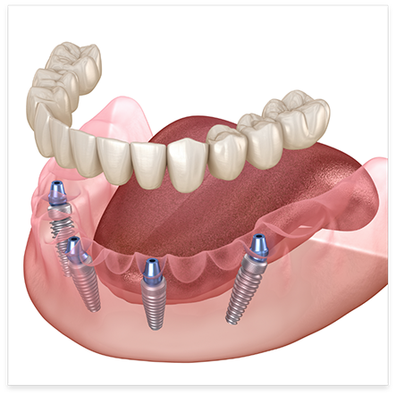 Illustration of dentures being attached to dental implants