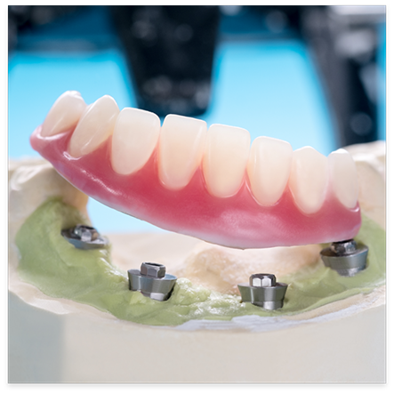 Dentures and dental implants inserted into model of jaw