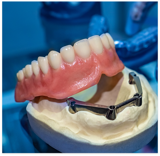 Full dentures in Cottonwood Heights on dental implant model