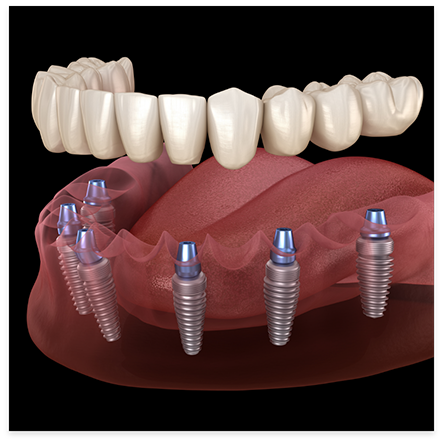 Illustration of dentures being attached to dental implants