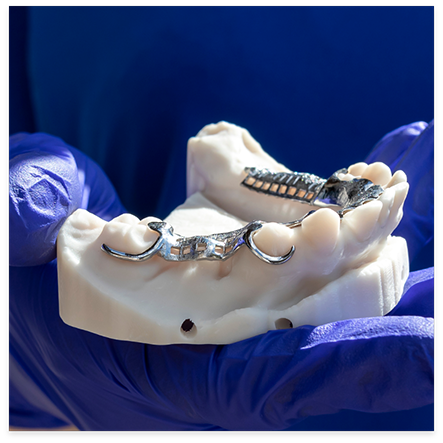 Partial dentures with metal framework on model of teeth