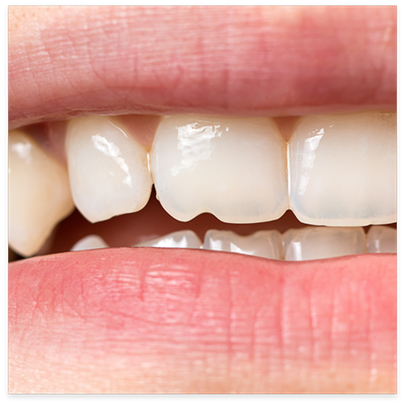 Close up of a damaged tooth