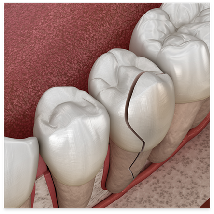 Illustration of cracked tooth in lower arch