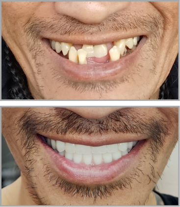 Smile before and after dental treatment