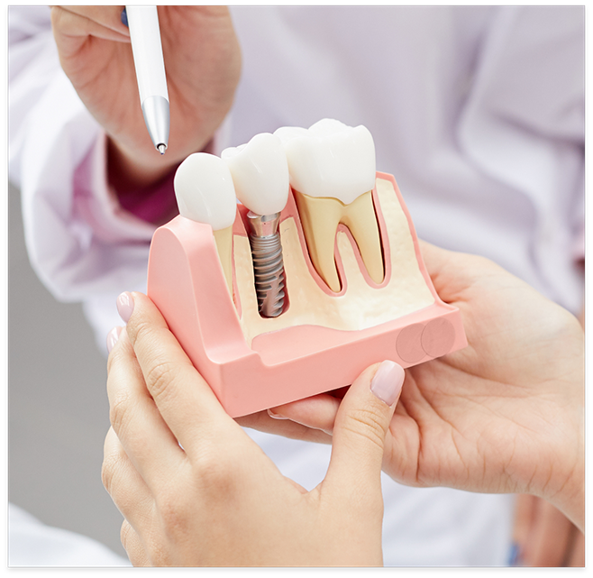 Holding a model of dental implant at dentists office