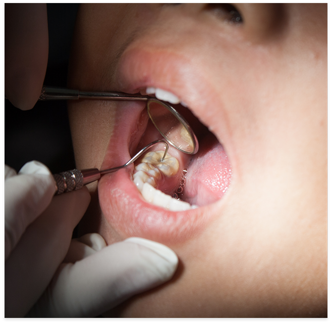 Close up of dental instruments being used to examine teeth