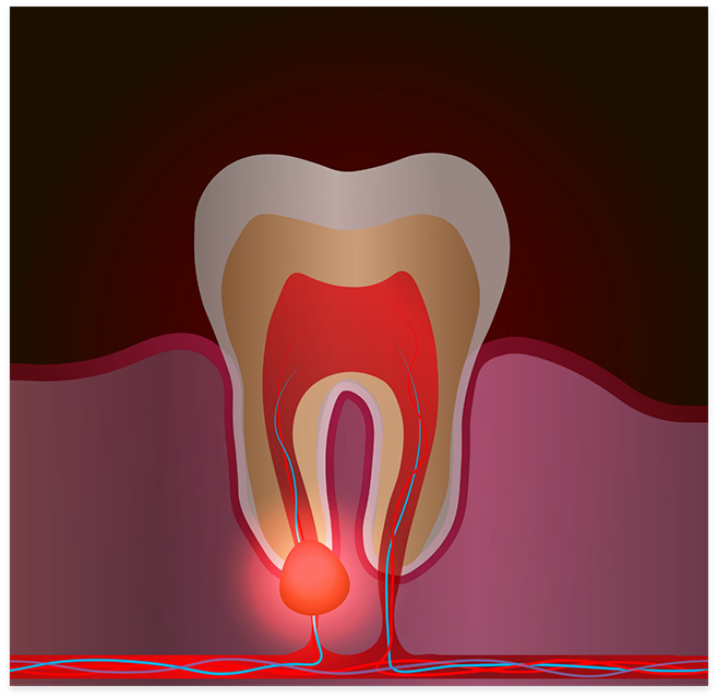 Illustration of a tooth suffering from infection