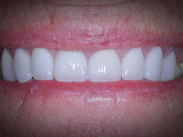 Smile with straight white teeth