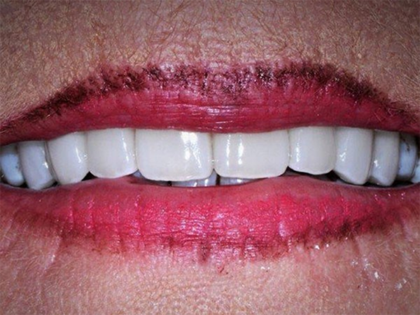 Smile with brighter better aligned teeth