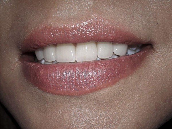 Smile with whitened teeth