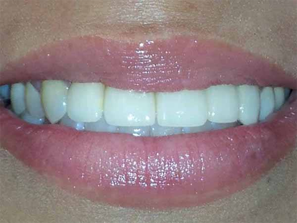 Close up of teeth after dental treatment