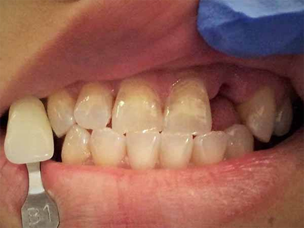 Close up of teeth before dental treatment