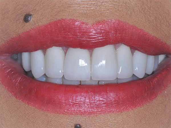 Smile with corrected teeth