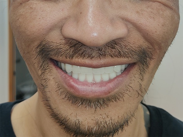 Smile with replacement teeth