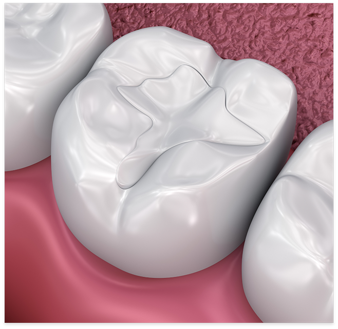 Illustration of tooth with tooth colored filling in Cottonwood Heights