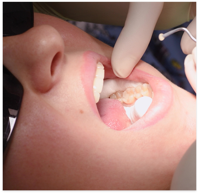 Close up of finger pointing to patients teeth