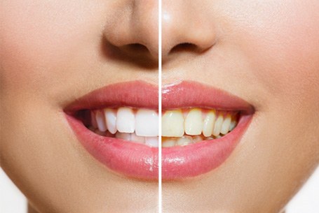 Before and after of a whitened smile