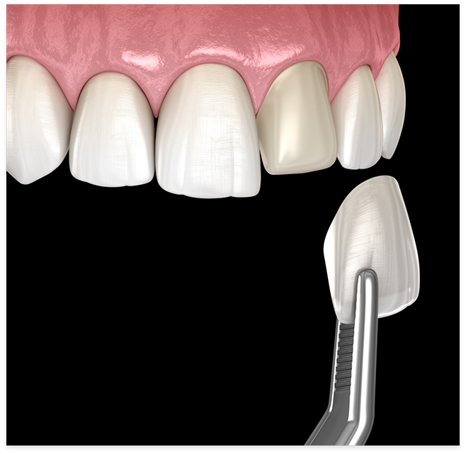 Illustration of veneers being placed on teeth