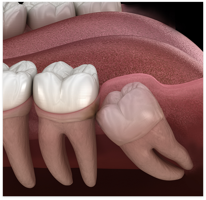 Illustration of wisdom tooth impacted under gums